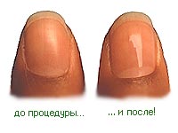 процедура запечатывания ногтей